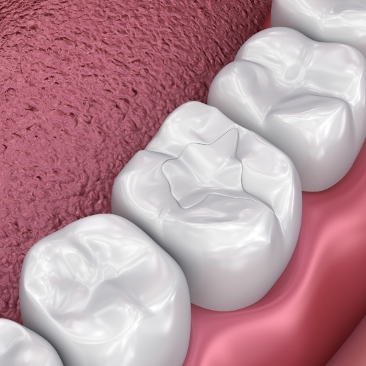 Animated row of teeth with dental sealants in Hammond