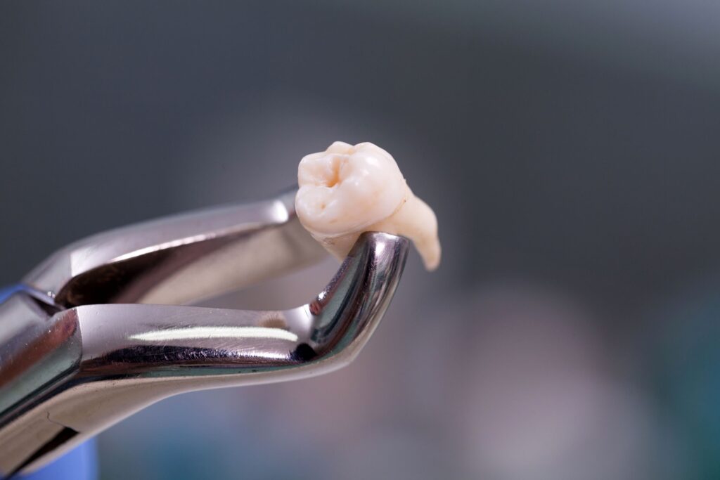 Closeup of extracted tooth held by forceps